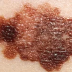 Científicos españoles descubren un ‘GPS’ del melanoma que podría ayudar a frenar la metástasis