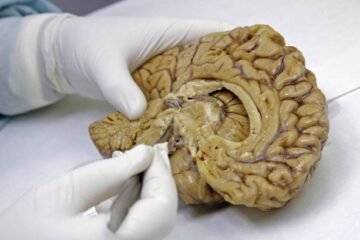 El hallazgo de una red cerebral que conecta cuerpo y mente apunta hacia mejores tratamientos contra el párkinson