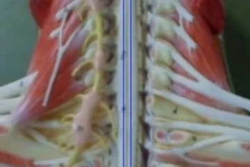 Avances esperanzadores en el primer implante mundial de una médula espinal artificial en un paciente con parálisis