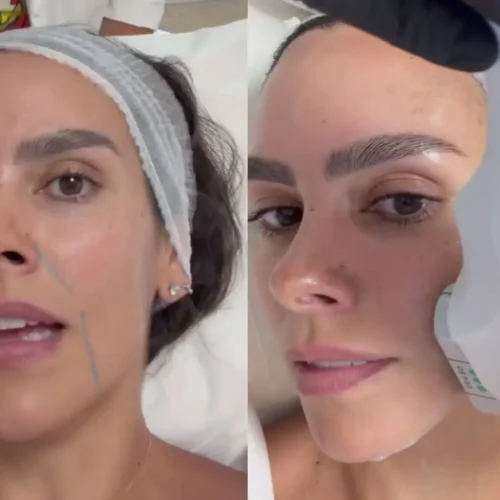 Cristina Pedroche se somete a un tratamiento para la flacidez de la cara: «Primera vez que me hago una cosa así»