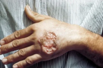 Probado con éxito en ratones un nuevo tratamiento para la leishmaniosis cutánea