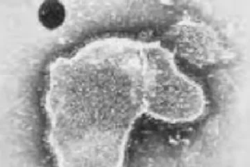Identifican los tres primeros casos de bronquiolitis por una mutación del VRS que desafía al tratamiento que protege a los bebés
